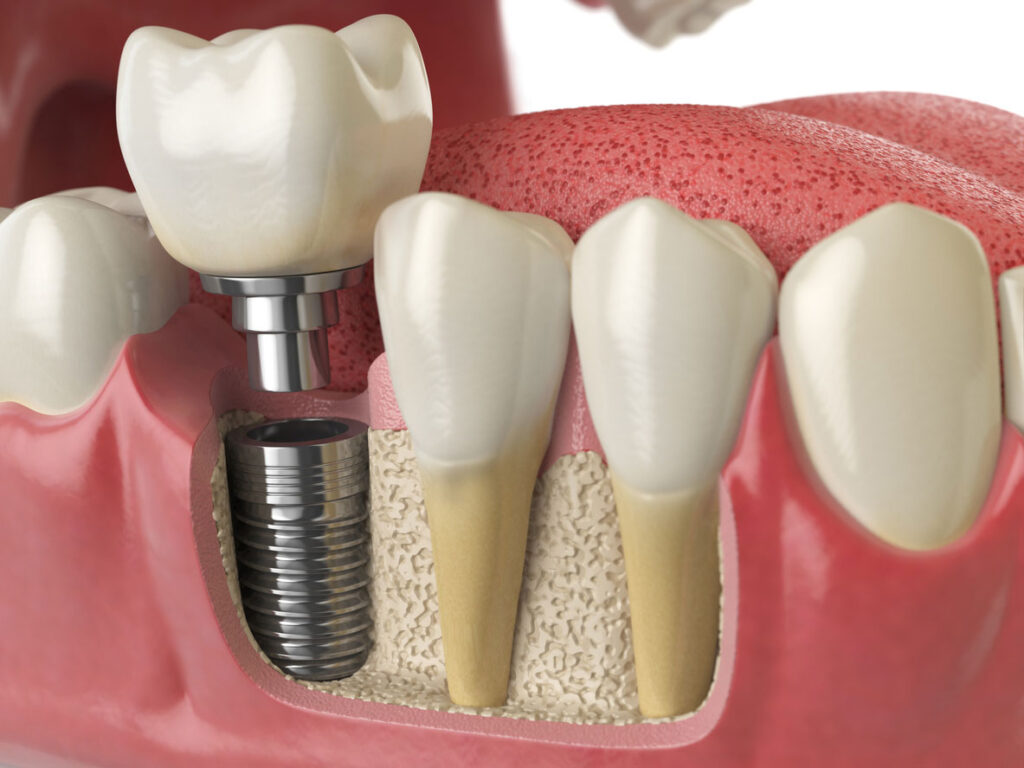 Dental Implants Berwick