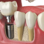 Dental Implants Berwick